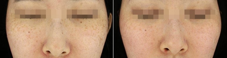 관악구피부과에서 색소집중모드로 주근깨,잡티 완벽제거한 후기(내돈내산,주근깨없애는법) 관련 이미지 7