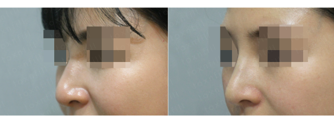 관악구피부과에서 매부리코 코필러가아닌 실로 콧대높히기 관련 이미지 3
