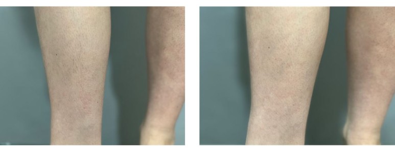 여자 레이저 제모 후기 (내돈내산) 서울대피부과 관련 이미지 1