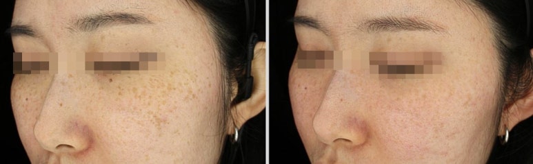 관악구피부과에서 색소집중모드로 주근깨,잡티 완벽제거한 후기(내돈내산,주근깨없애는법) 관련 이미지 6
