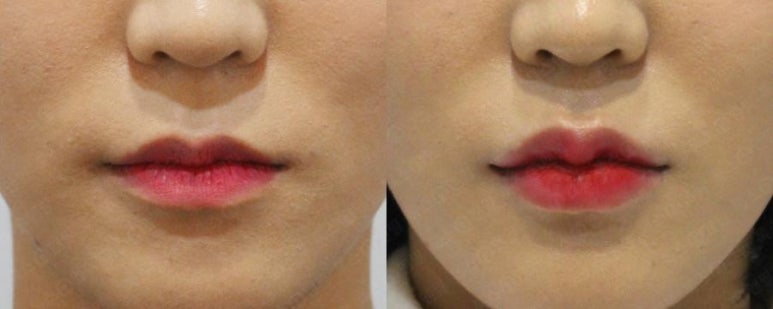 서울대입구역 피부과 자연스러운 쁘디성형 입술필러 관련 이미지 4