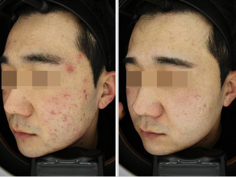 서울대입구역 피부과 톡스앤필 여드름치료 관련 이미지 5