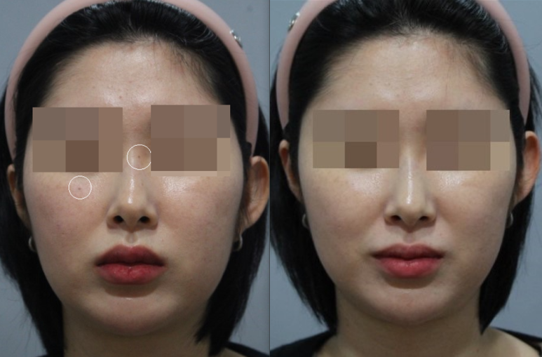 서울대입구역피부과 점빼기는 여기서 어때? 관련 이미지 3