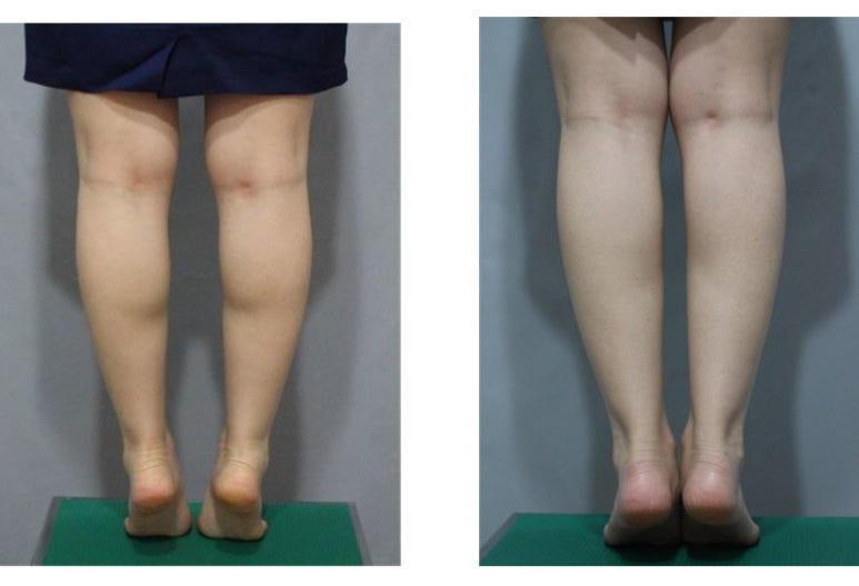 [톡스앤필관악점] 종아리 알 스트레스 받지말고! 종아리보톡스로!! 종아리보톡스 후기!! 관련 이미지 1