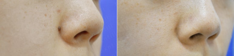 서울대입구역피부과에서 점빼기,점제거,사마귀제거 관련 이미지 2