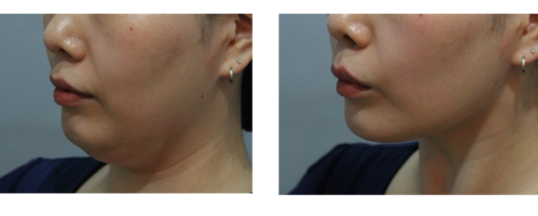 [톡스앤필관악점] 리프팅의 마침표, 인모드FX!! 인모드의 생생한 후기!! 관련 이미지 1