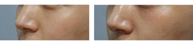 서울대입구역피부과에서 아쿠아필링으로 피부관리받고 푸석해진 피부 개선된 후기 (내돈내산,아쿠아필가격) 관련 이미지 2