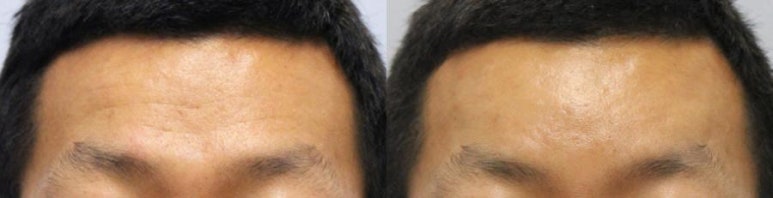 관악구 피부과에서 나이들어보이는 얼굴 이마필러로 (전후사진,효과) 관련 이미지 3