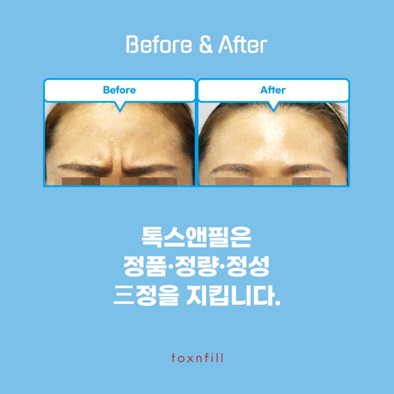 톡스앤필 미간보톡스 파격 할인?! 관련 이미지 6