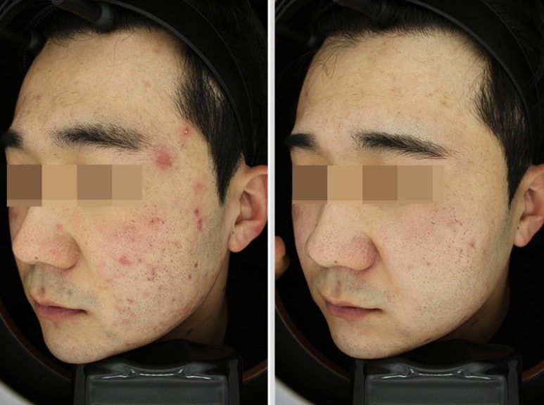 관악구피부과에서 받은 여드름치료 #강력추천! 관련 이미지 4