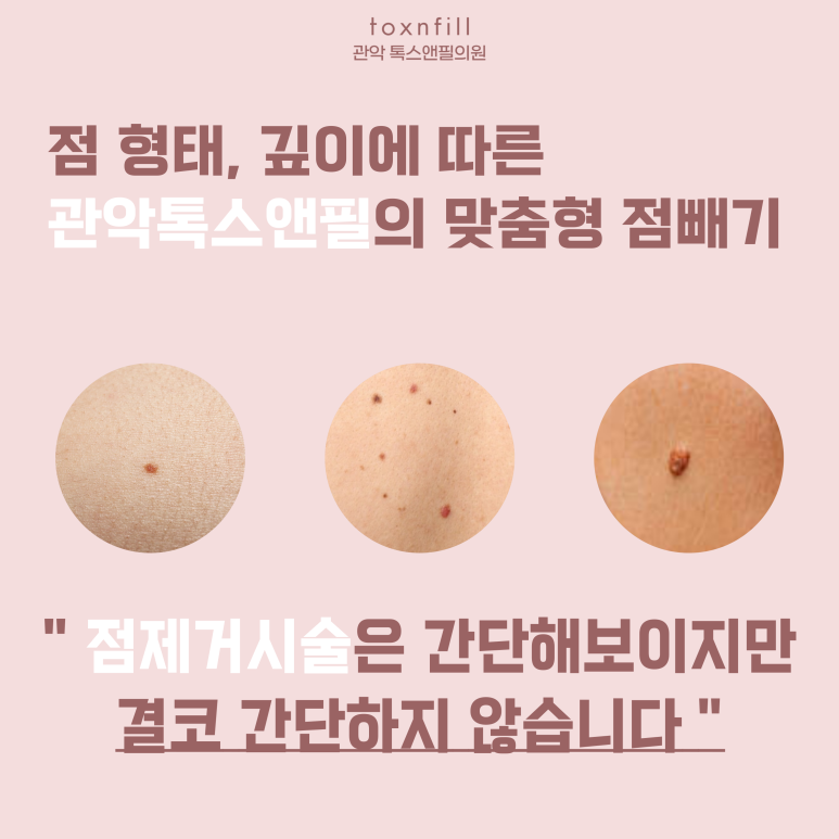 관악구 피부과에서 점제거,점빼기 효과만점 관련 이미지 2