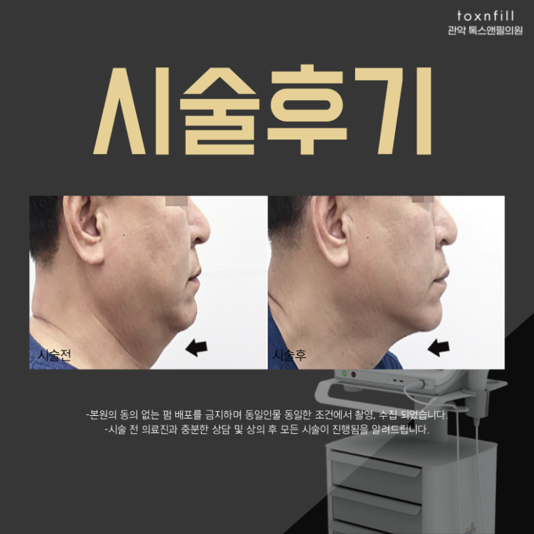 [톡스앤필 서울대점] 강력한 리프팅 관련 이미지 5