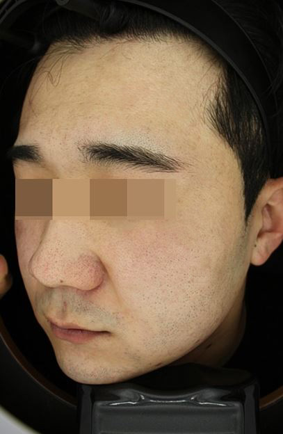 서울대입구역피부과에서 여드름치료가 중요한 이유(5주간의 후기) 관련 이미지 5