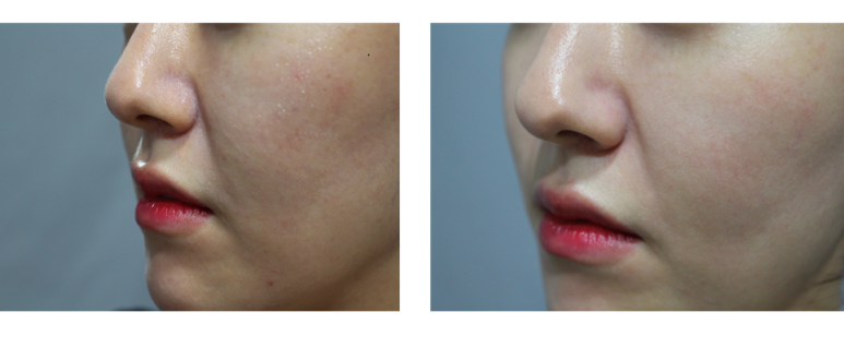 [톡스앤필관악점] 넓어진모공과 피부각질에는 아쿠아필로 한방에! 블랙헤드박살! 아쿠아필 후기!! 관련 이미지 1