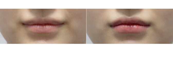 [톡스앤필관악점] 입술필러?어디서해?톡스앤필에서해!! 관련 이미지 1