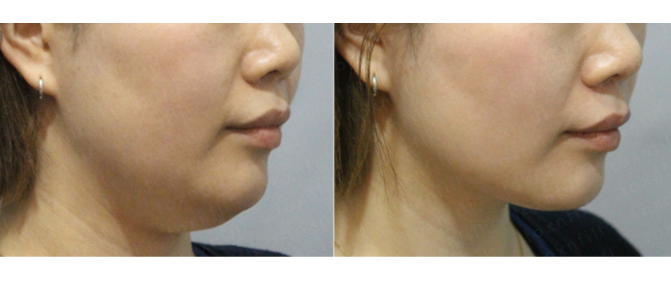 관악구피부과에서 윤곽주사로 얼굴 v라인만들고 다이어트효과 본 후기(윤곽주사전후) 관련 이미지 2