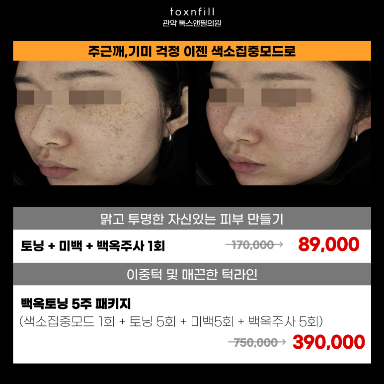 서울대입구역피부과에서 주근깨 없애는 방법 관련 이미지 5