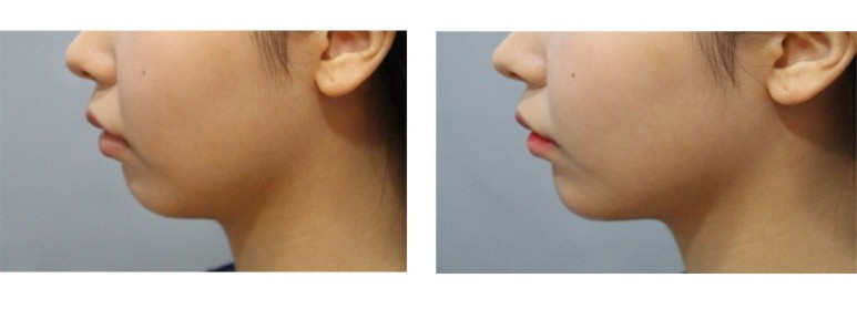 관악구피부과에서 추천드리는 투턱주사!턱끝필러 이중턱 없애기 프로젝트!! 후기와정보 추가!^^* 관련 이미지 1