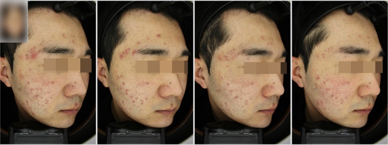 관악구피부과에서 여드름치료 5주간 리얼 후기!(내돈내산) 관련 이미지 6