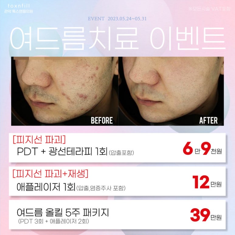 서울대입구 코필러 5월말까지의 다양한 시술 이벤트! 관련 이미지 5