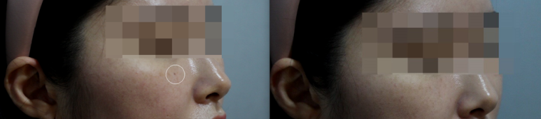 관악구피부과에서 확실한 점빼기,점제거는 CO2로 관련 이미지 4