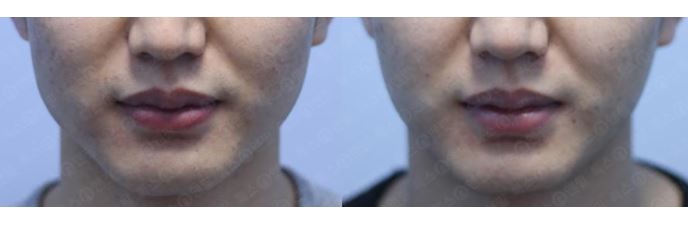 [톡스앤필관악점] 각진얼굴이제그만!! 갸름한 얼굴라인을 원한다면? 사각턱보톡스후기 관련 이미지 1