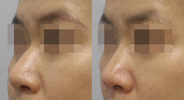 관악구피부과에서 수술이 아닌 코필러로 콧대살린후기 관련 이미지 2