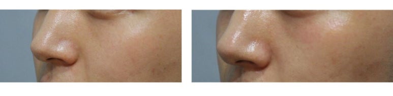 [톡스앤필관악점]  블랙헤드?! 피부관리는 아쿠아필로!! 관련 이미지 1