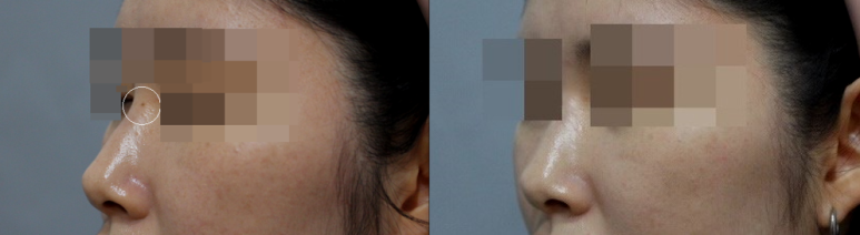 관악구피부과에서 확실한 점빼기,점제거는 CO2로 관련 이미지 5