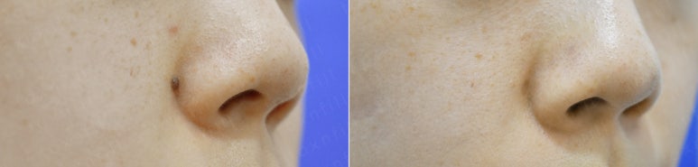 관악구 피부과에서 점제거,점빼기 효과만점 관련 이미지 3