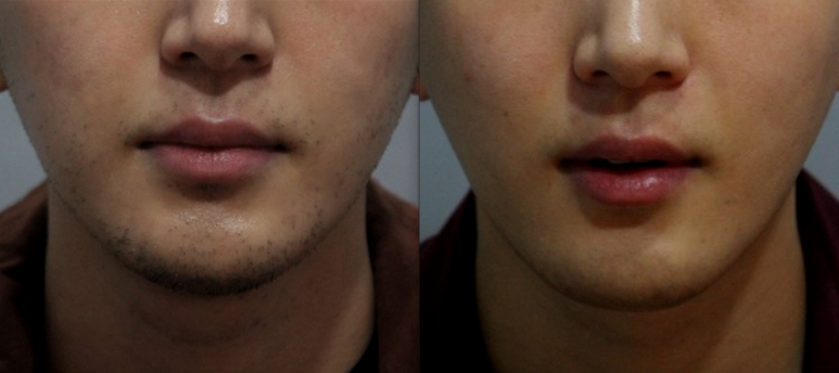 서울대입구역 남자 레이저제모 할인혜택 챙기기 관련 이미지 7