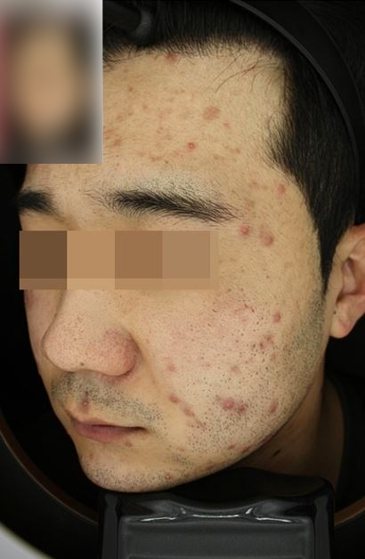 관악구피부과에서 여드름치료로 깨끗한피부 되찾기 관련 이미지 2