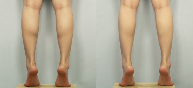 [톡스앤필관악점] 종아리보톡스 알고맞자!! 관련 이미지 1