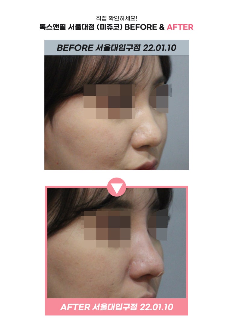 서울대입구역피부과 미쥬코 코필러로 아름다운 코라인을 관련 이미지 6