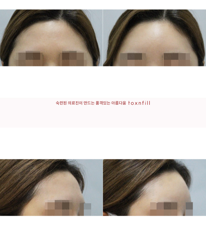 [톡스앤필관악점] 푹~꺼진이마 이마필러로 옆라인 아름답게 만들자!! 관련 이미지 1
