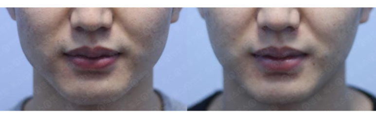 [톡스앤필관악점] 사각턱보톡스맞고 v라인 가능!! 관련 이미지 1