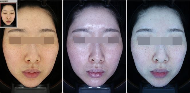 관악구피부과에서 색소집중모드로 주근깨,기미 전부 제거한 후기! 진심효과최고! (내돈내산) 관련 이미지 3