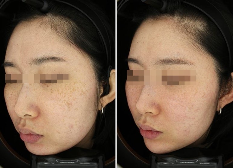 관악구피부과에서 색소집중모드로 주근깨,잡티 완벽제거한 후기(내돈내산,주근깨없애는법) 관련 이미지 5