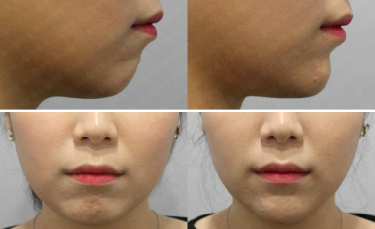[톡스앤필관악점] v라인의 시작은 턱끝필러로!! 관련 이미지 1
