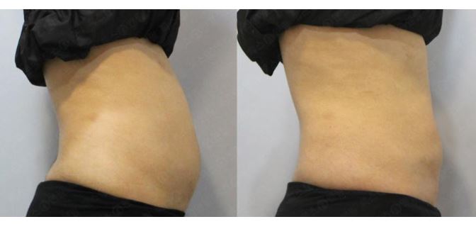 [톡스앤필관악점] 뱃살관리?? 이제는 빼라피로 관리하자!! 빼라피 후기!! 관련 이미지 1