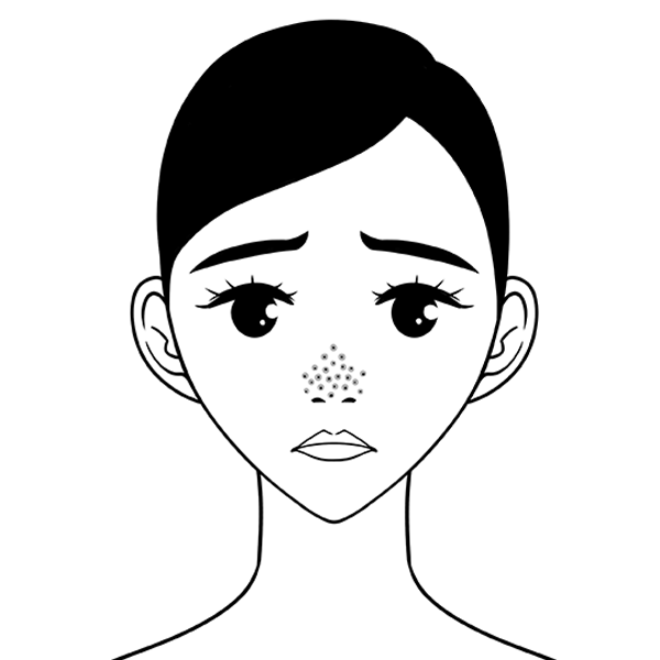 봉천동 시크릿레이저 여드름 및 흉터 개선과 모공치료 관련 이미지 2