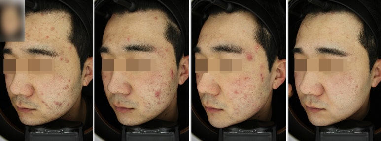 서울대입구역피부과 여드름 박멸한 후기 관련 이미지 3