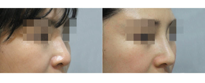 [톡스앤필관악점] 콧대 수술?NO! 이젠 시술로!! 관련 이미지 1