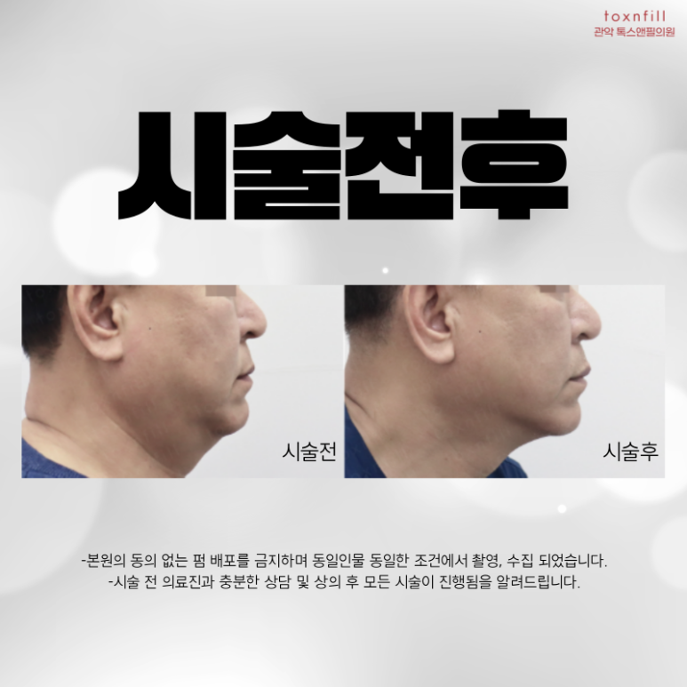 [이벤트] 강력한 리프팅,지속력 오래가는 프리미엄 리프팅 울쎄라 관련 이미지 5