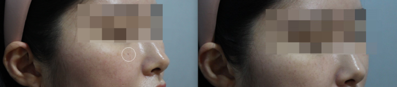 서울대입구역피부과 점빼기는 여기서 어때? 관련 이미지 4