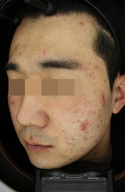 서울대입구역피부과에서 여드름치료가 중요한 이유(5주간의 후기) 관련 이미지 3