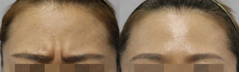 서울대입구역 피부과 미간 주름이 계속 신경쓰인다면? 미간보톡스가 정답! 관련 이미지 2