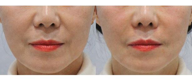 [톡스앤필관악점]관악구피부과에서 강추하는 팔자주름필러후기!! 내돈내산이죠? 관련 이미지 1