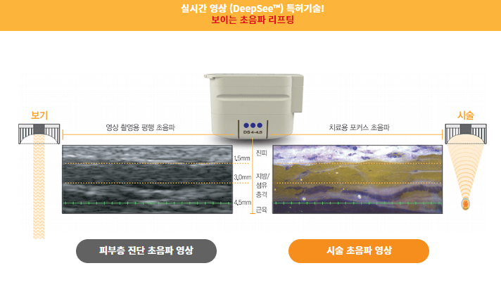 [톡스앤필 서울대점] 강력한 리프팅 관련 이미지 4