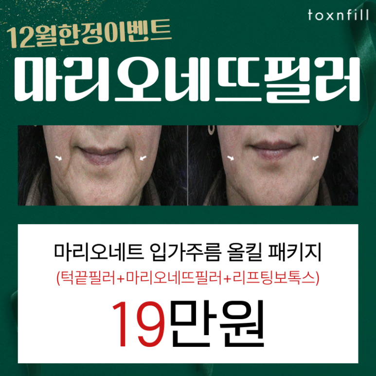 [톡스앤필서울대점] 마리오네트 주름필러 완벽제거 12월한정 이벤트! 관련 이미지 1